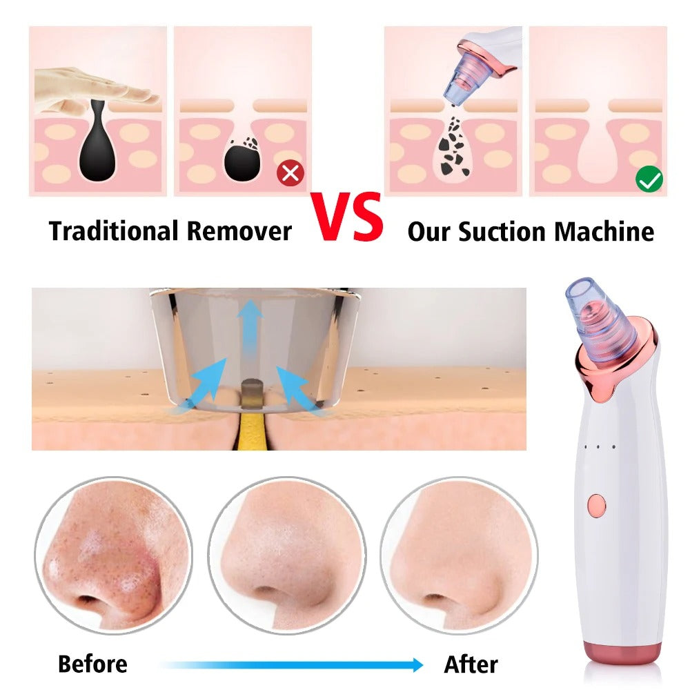 Blackhead Beauty Instrument / Pore Cleaner